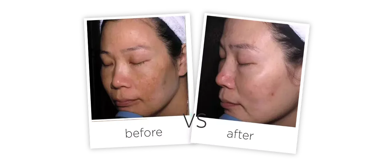 Picosecond Laser,PS2014 Treatment Before&After