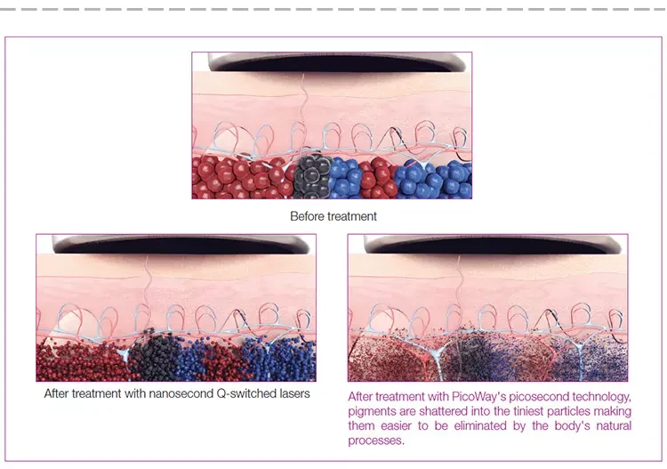 Picosecond Laser Machine images