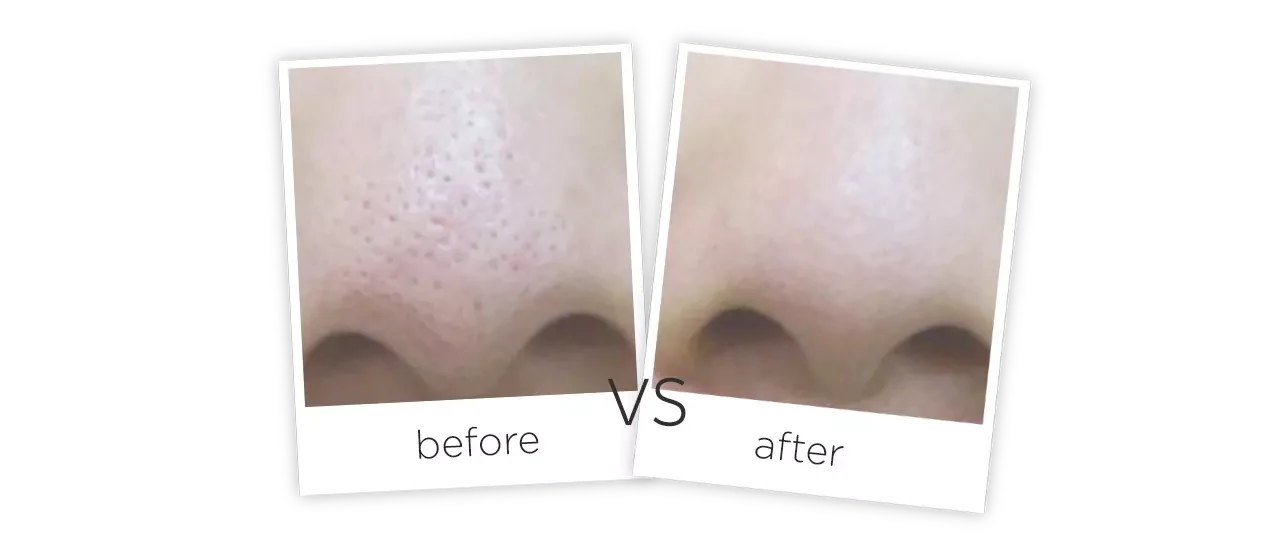 Hydra Facial Machine Treatment Before And After