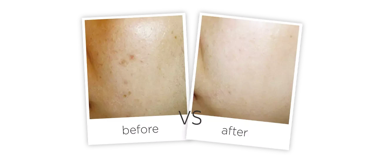 Hydra Facial Machine Treatment Before And After