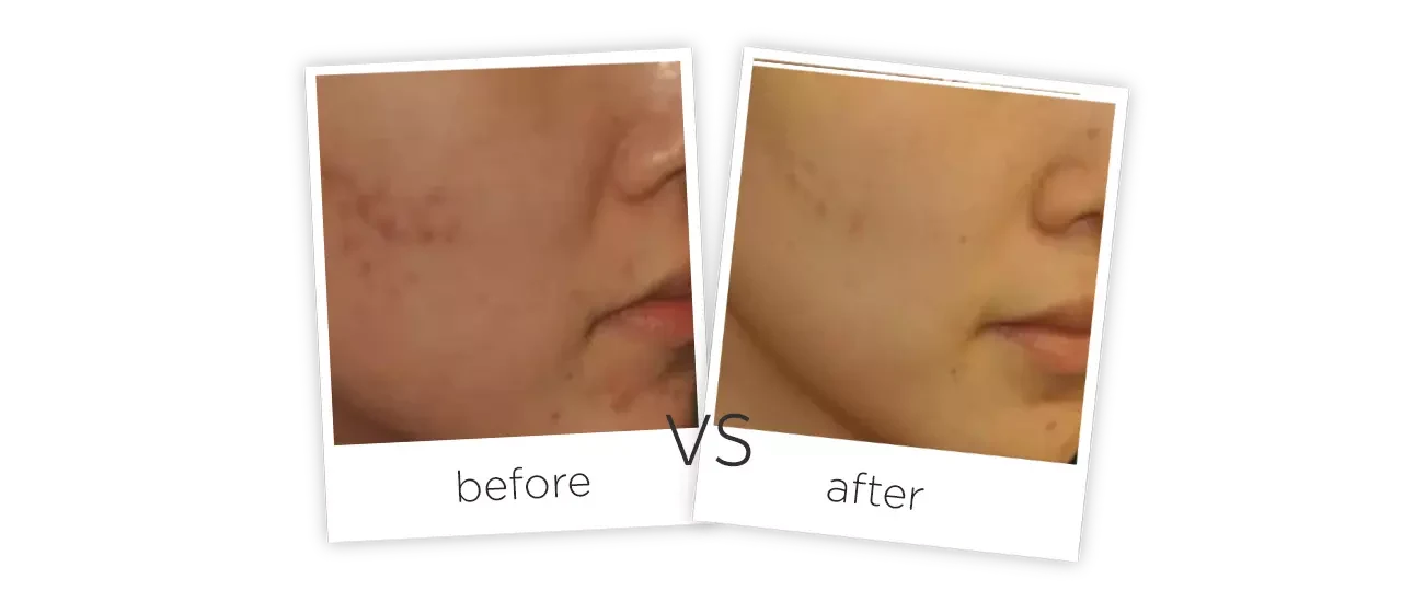 Skin Whitening Biological Light Therapy Before&After