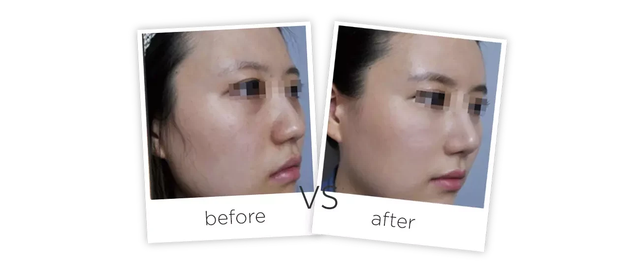 Skin Whitening Biological Light Therapy Treatment results
