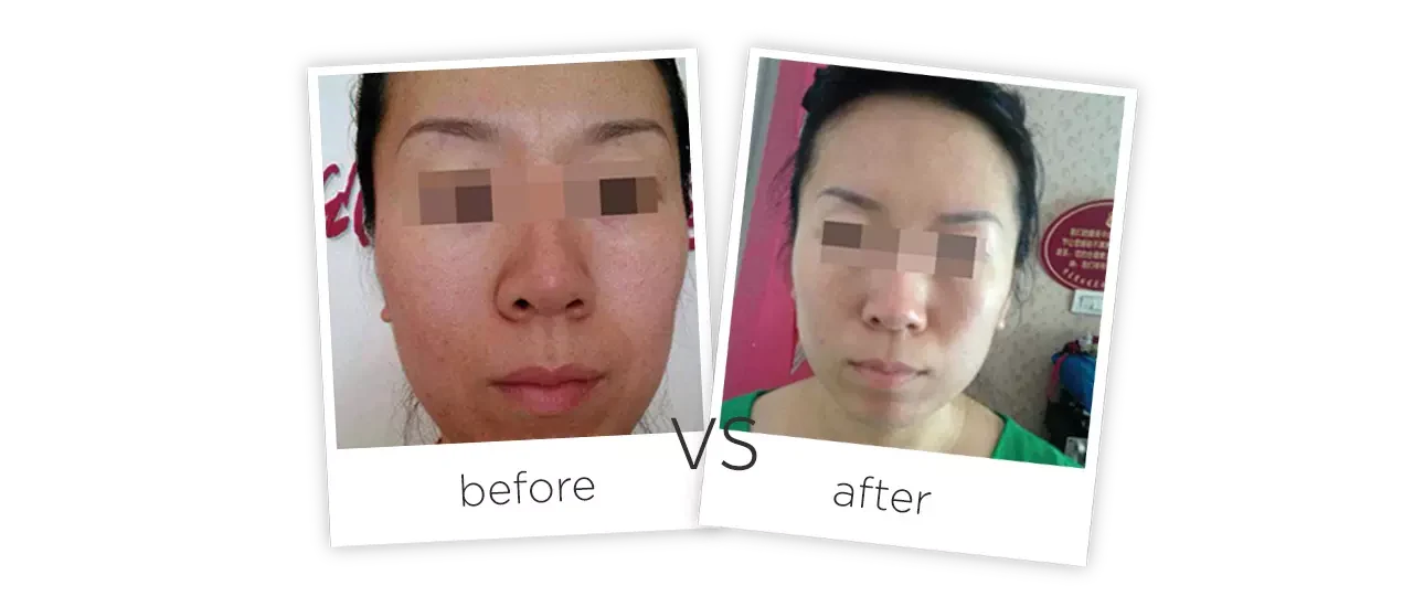 Skin Whitening Biological Light Therapy Treatment Before&After