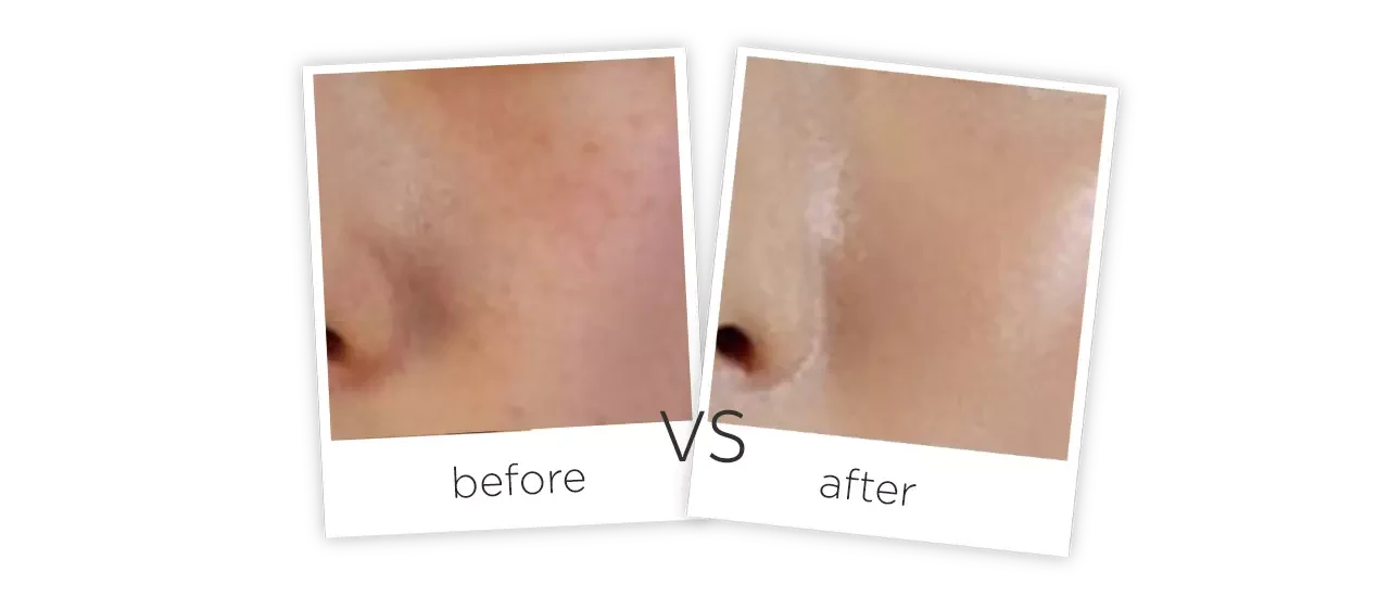 Mesotherapy meso gun, hydra magic beauty machine Before&After