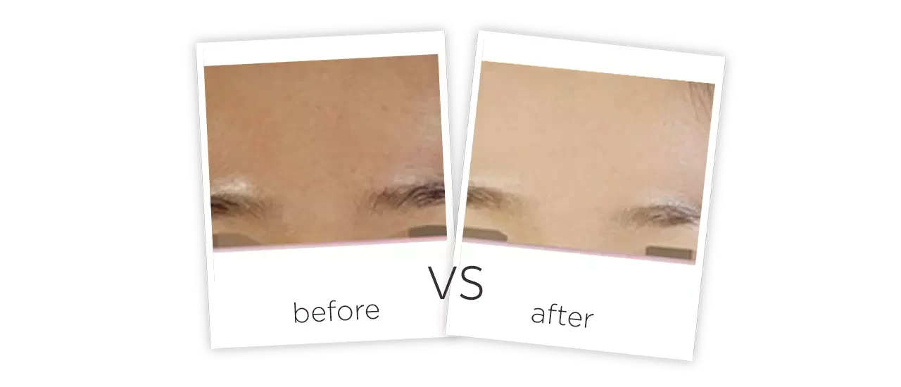 Mesotherapy meso gun, hydra magic beauty machine Treatment results