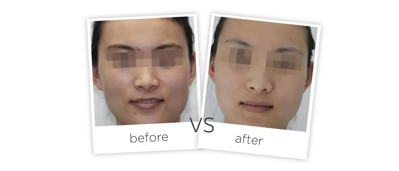 SHR facial rejuvenation Before and After SHR facial rejuvenation Before and After