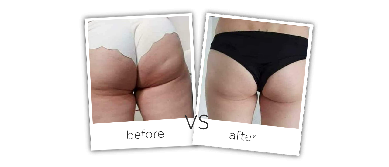 Treatment / Body Shaping Before&After
