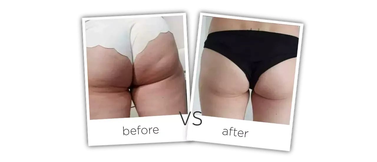 Treatment  /  Body Shaping Before&After