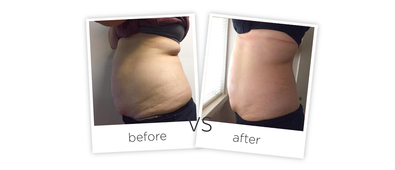 Treatment / Body Shaping Treatment results