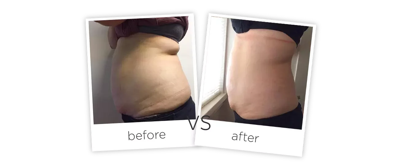 Vacuum Shape ,VS+ Treatment results
