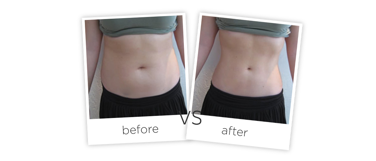 Treatment / Body Shaping Treatment Before&After