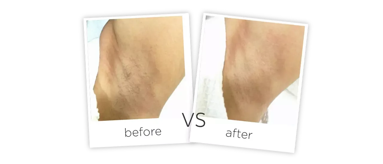 Diode Laser Hair Removal Machine FG 2000-B Before&After