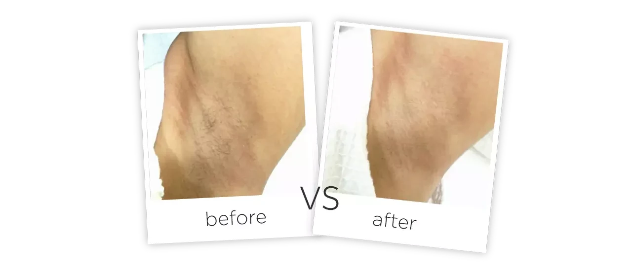 photos before and after treatment of Legs Diode Laser Hair Removal 