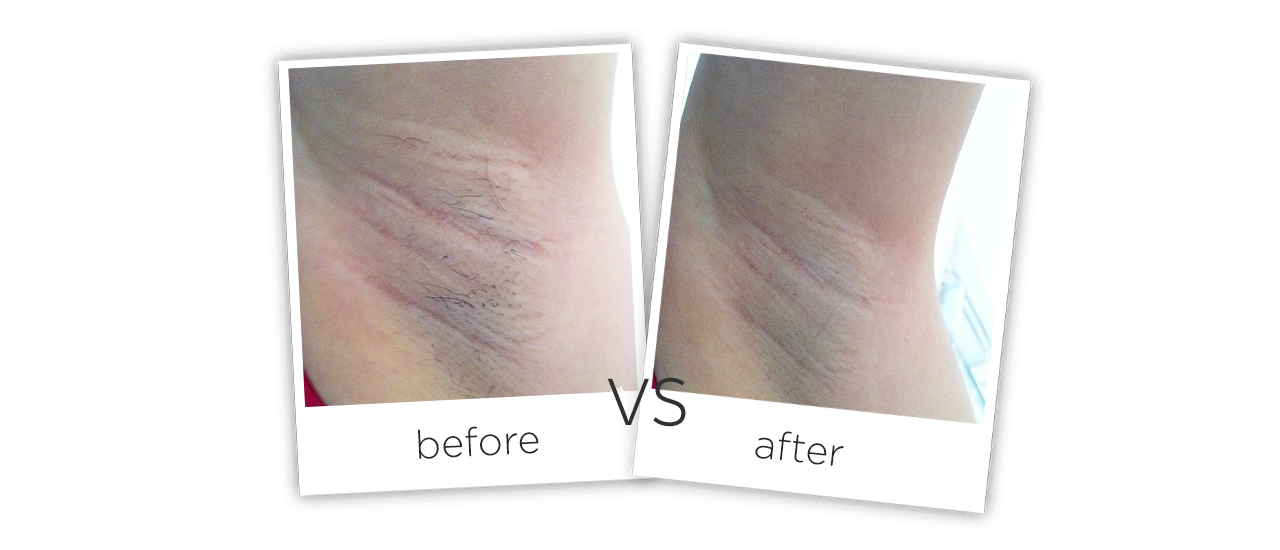 comparing images before and after SHR hair removal treatment comparing images before and after SHR hair removal treatment
