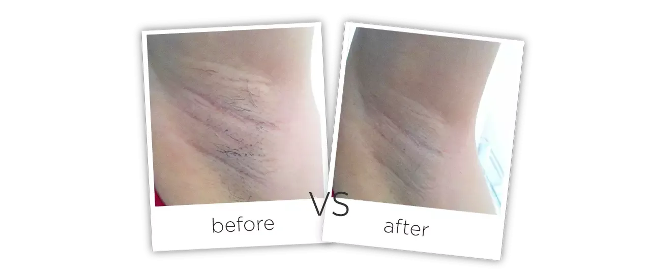 Diode Laser Hair Removal Machine FG 2000-B Treatment results