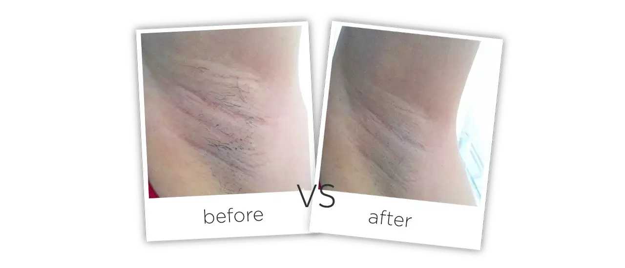 Laser Hair Removal Before and After Laser Hair Removal Before and After
