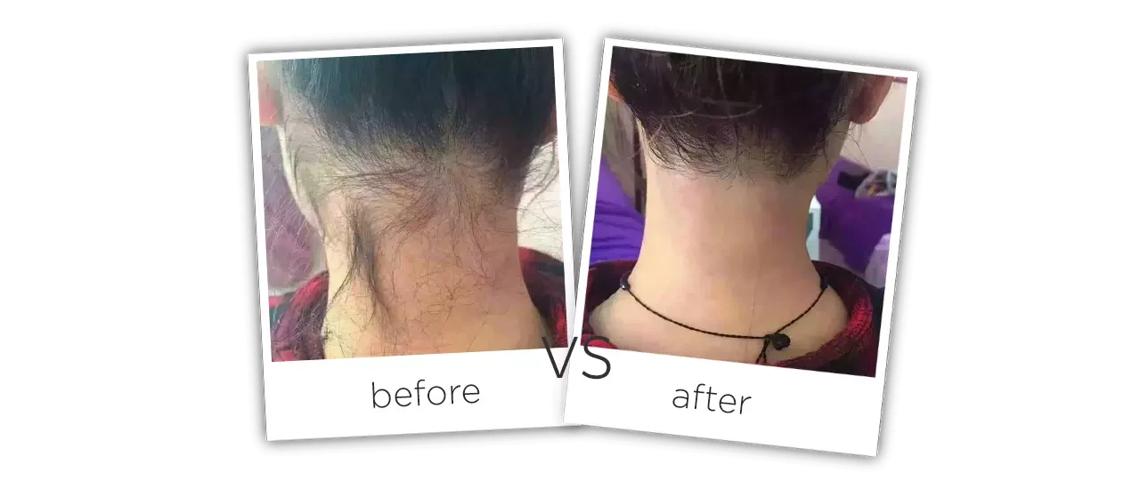 808nm Diode Laser Hair Removal System Treatment Before&After