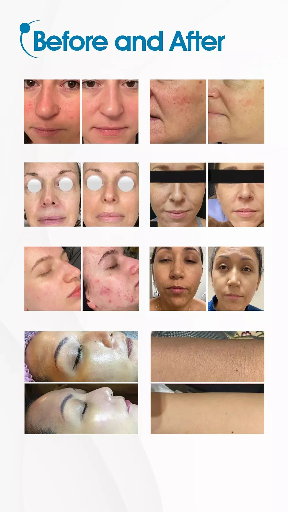 BBL Hair Removal Skin Rejuvenation Machine PDF Download