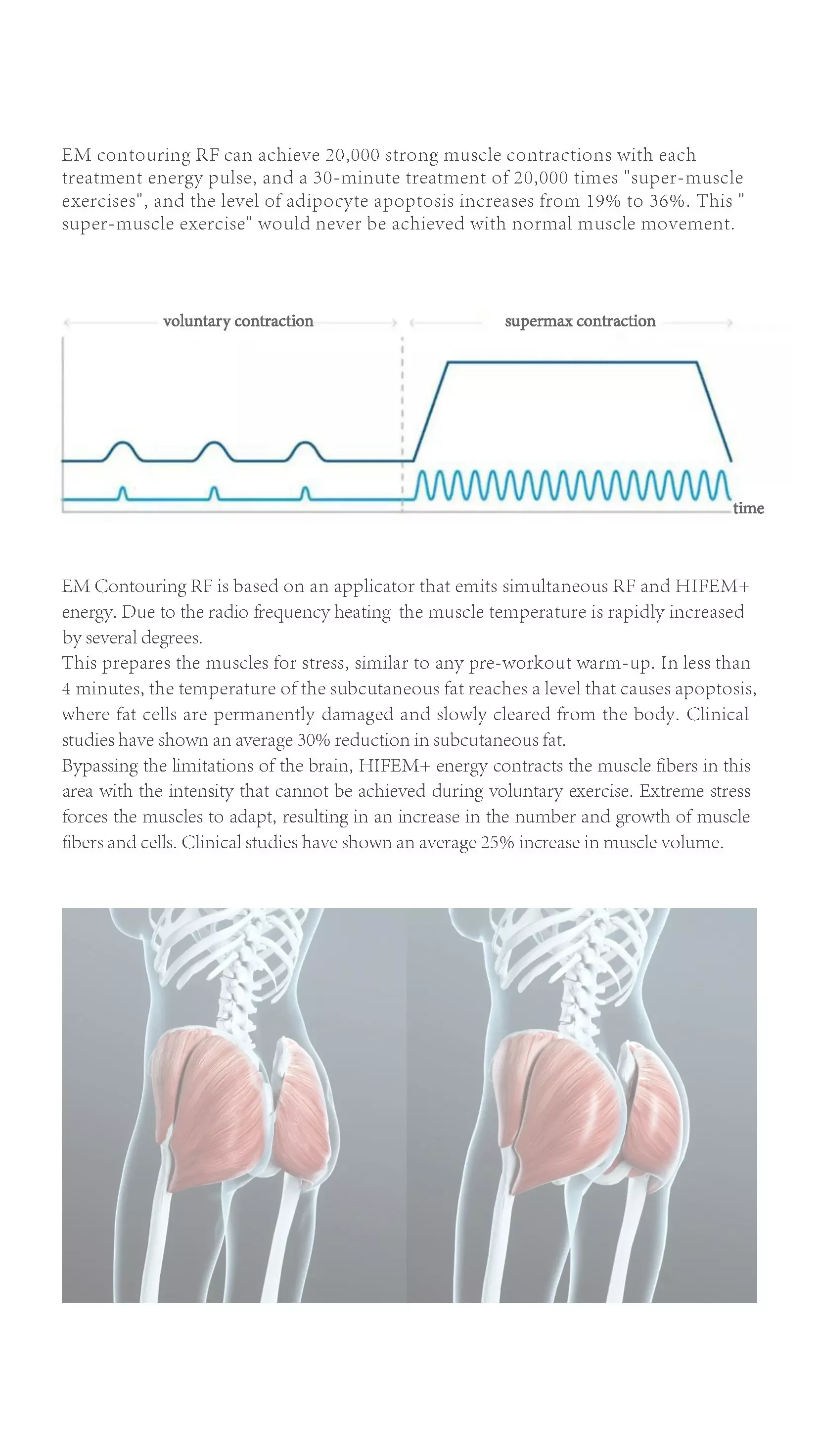 EM-Contouring RF Machine PDF