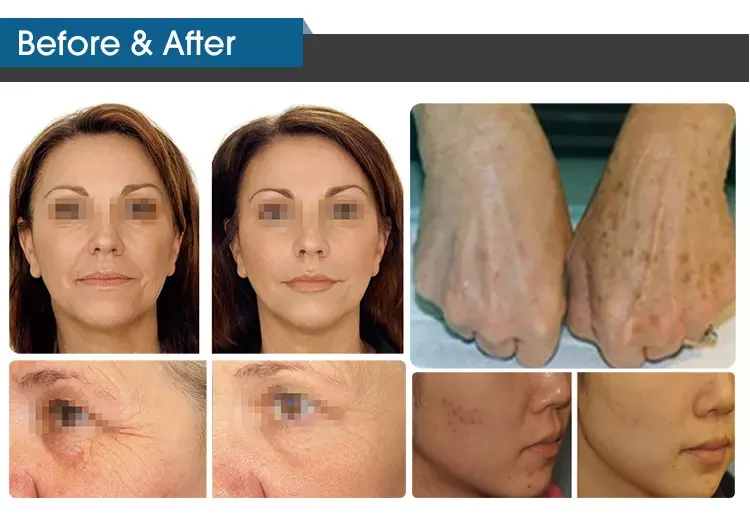 Skin Whitening Biological Light Therapy images Skin Whitening Biological Light Therapy images
