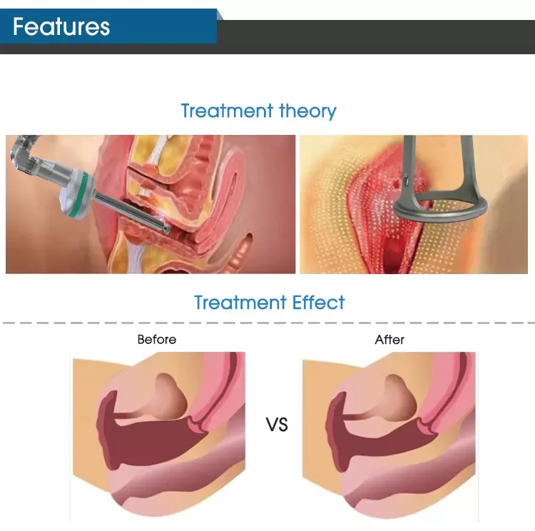 Portable Radio Frequency(RF) Fractional Co2 Laser