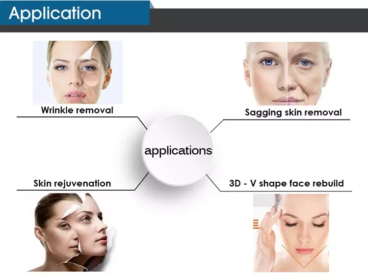 HIFU Facial Wrinkle Removal machine