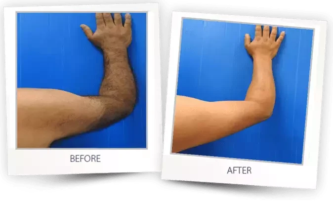 Arm treatment